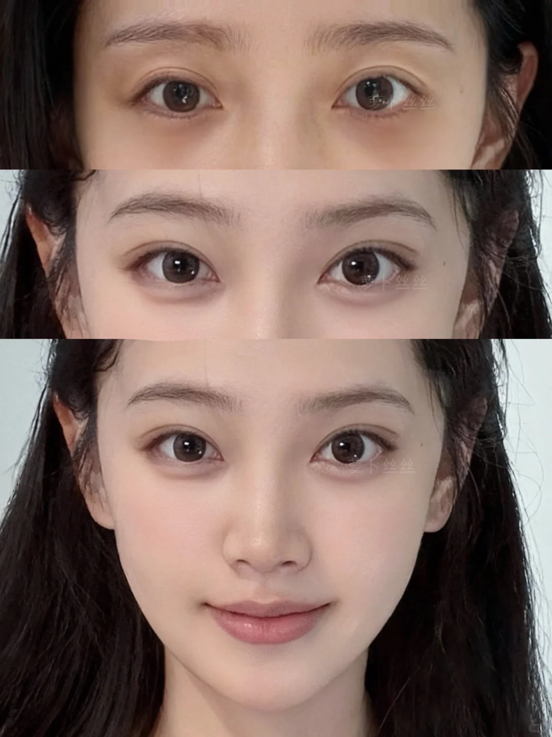 35岁首次尝试一针打飞眼尾！