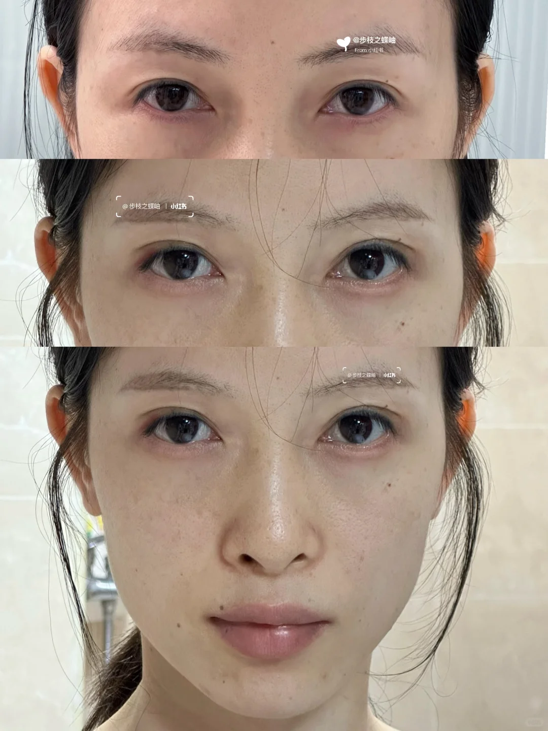 打了一针上扬的不仅仅是眼尾！脸都提起来了