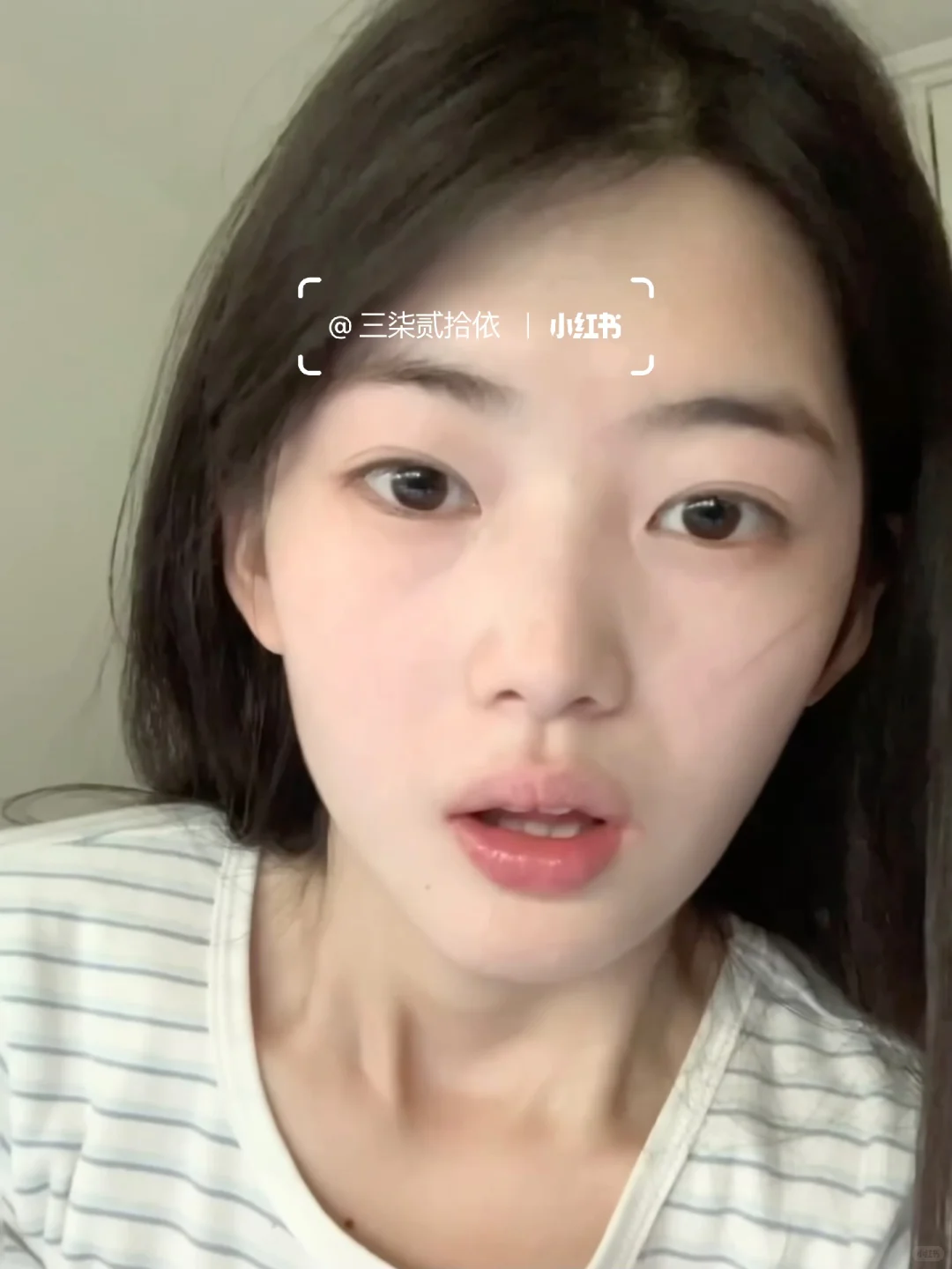 尝试一针打飞眼尾没想到面相都变了～