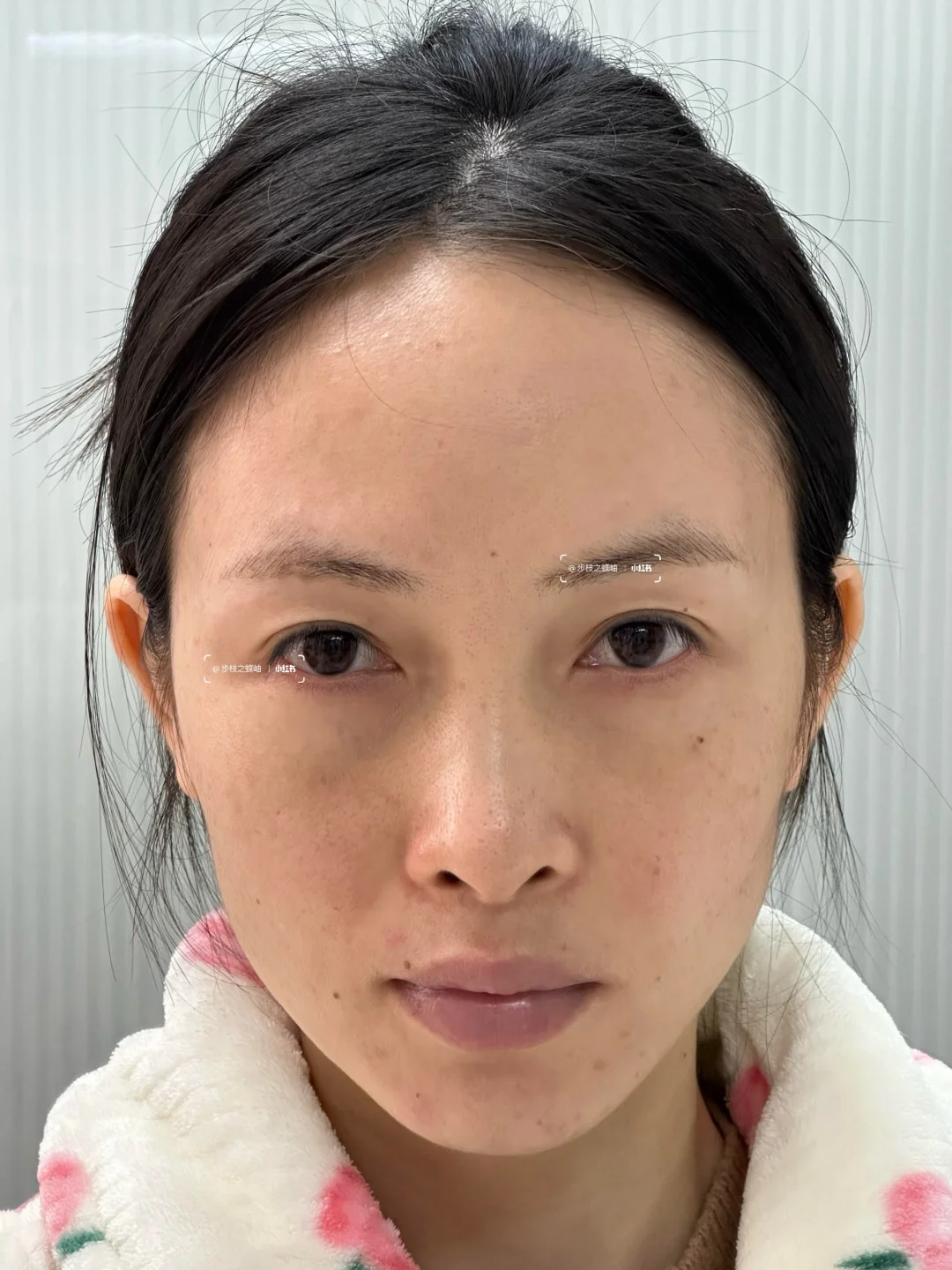 打了一针上扬的不仅仅是眼尾！脸都提起来了