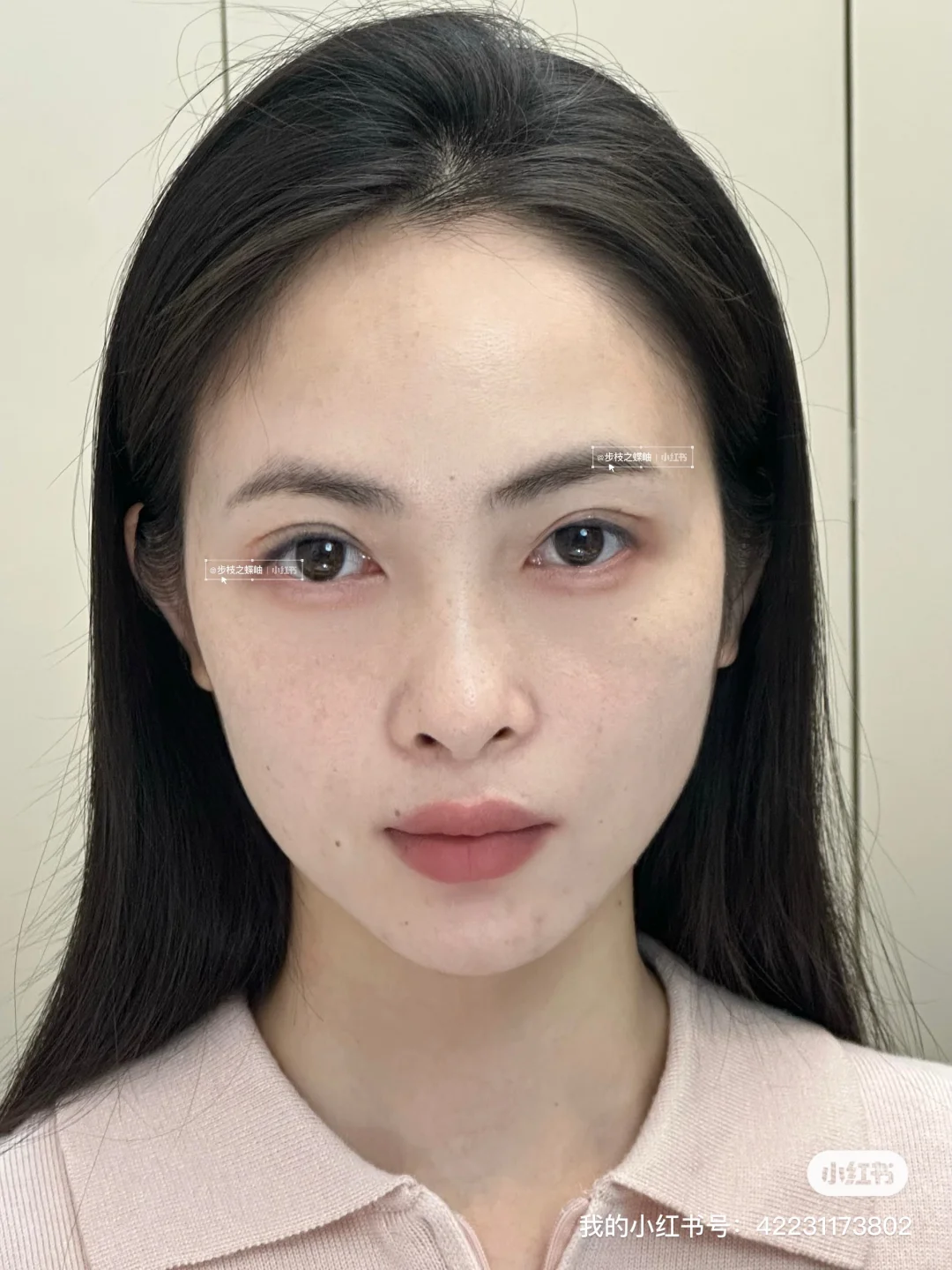 打了一针上扬的不仅仅是眼尾！脸都提起来了