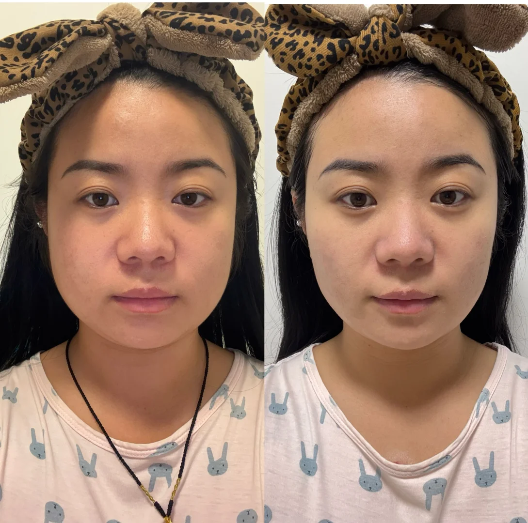 面吸🍜完的第38天对比图来啦～