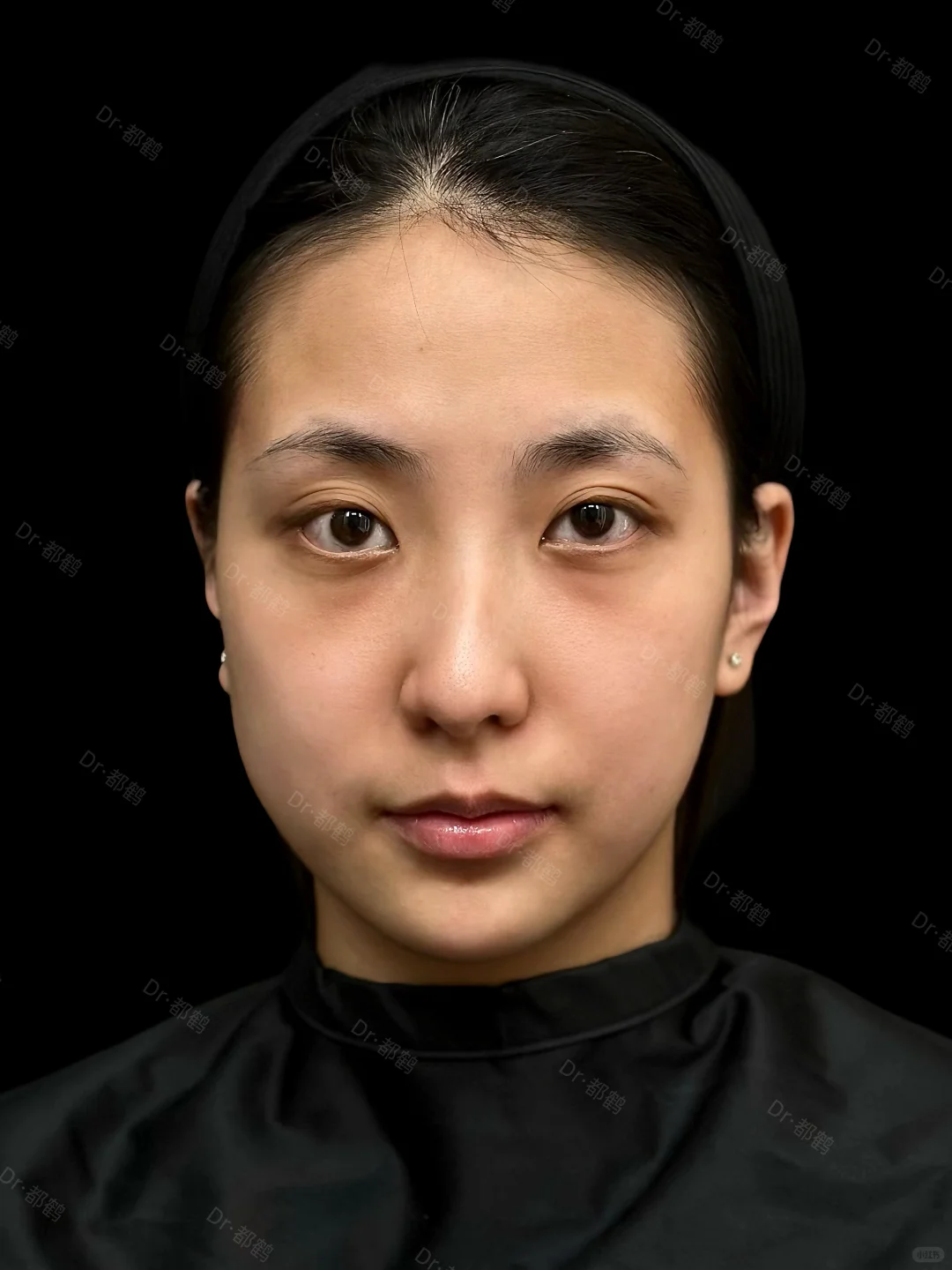 大连注射｜长脸💦轮廓凹凸凹的姐妹进