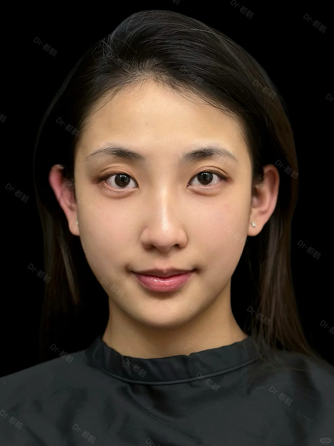 大连注射｜长脸💦轮廓凹凸凹的姐妹进