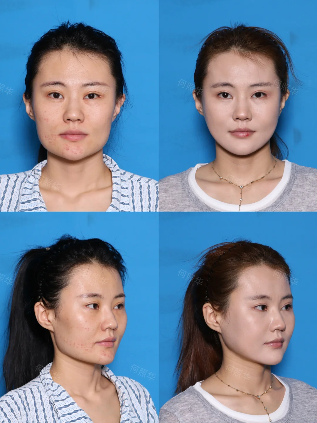 北京Ⅰ阔面菱形脸自救攻略❗❗