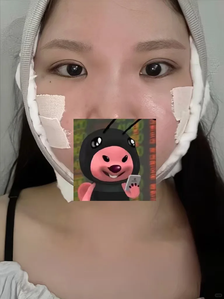 03年女大磨颧骨下颌角第8天