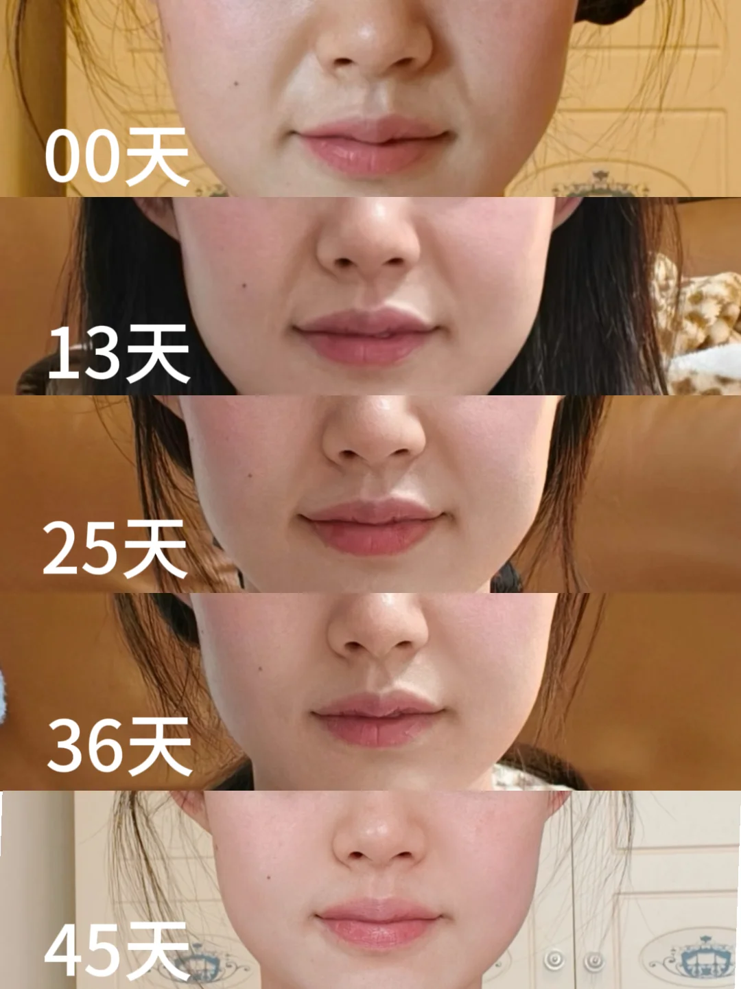 重度垮脸+揉穴位=绝杀（45天实感）