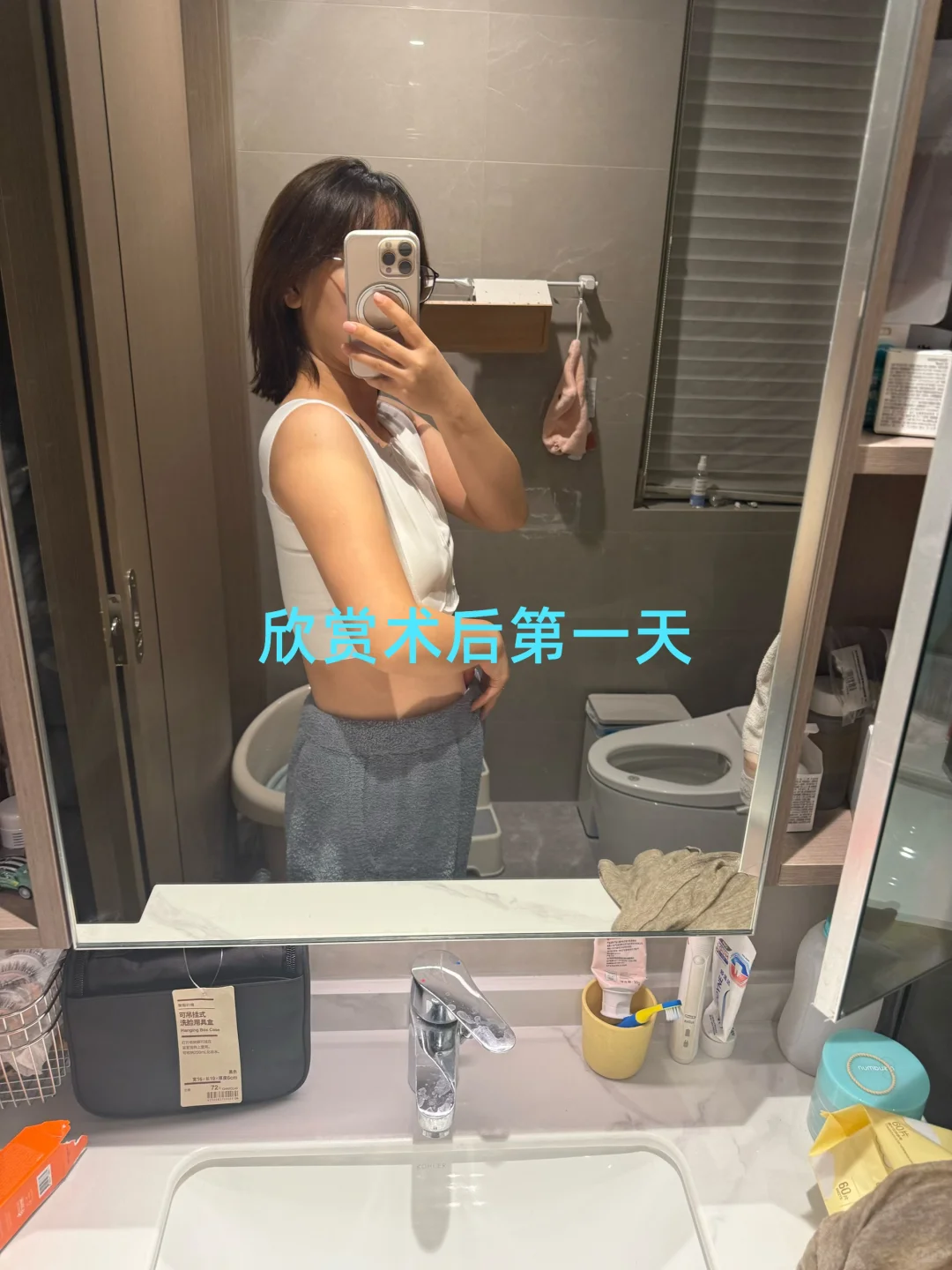 乳腺导管瘤门诊切除手术之邵逸夫