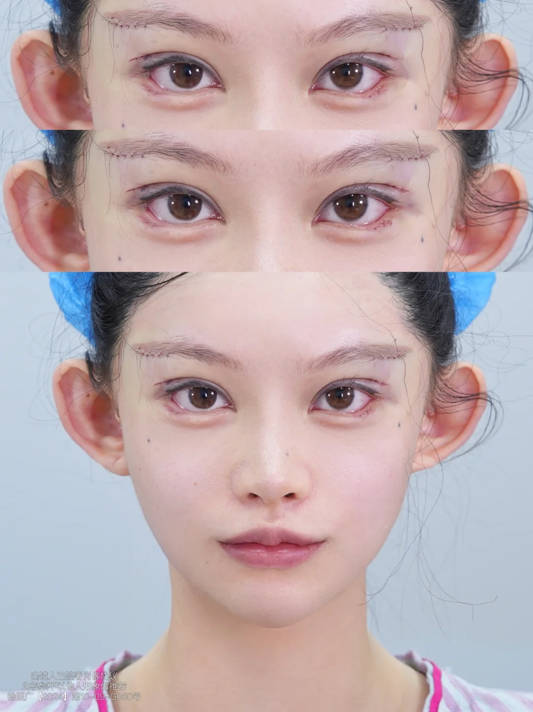 上海双眼皮～狐系眼👀修get✔️