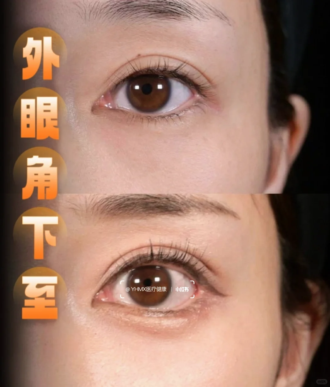 无痕下至外眼角1个月