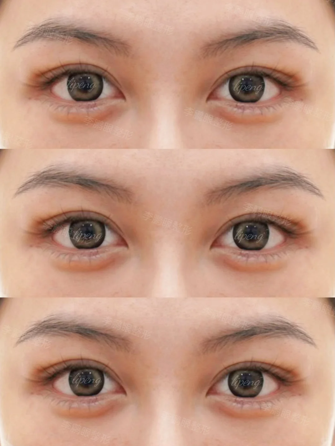 深圳7mm双眼皮，勾人狐狸眼~