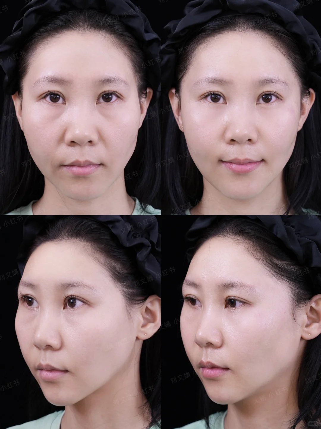 石家庄玻尿酸丨5ml太阳穴凹陷轮廓微调