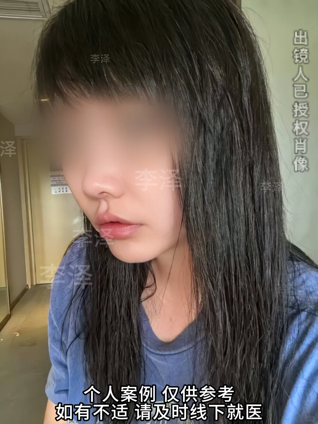 天津的求美者人中三件套术后第一天反馈