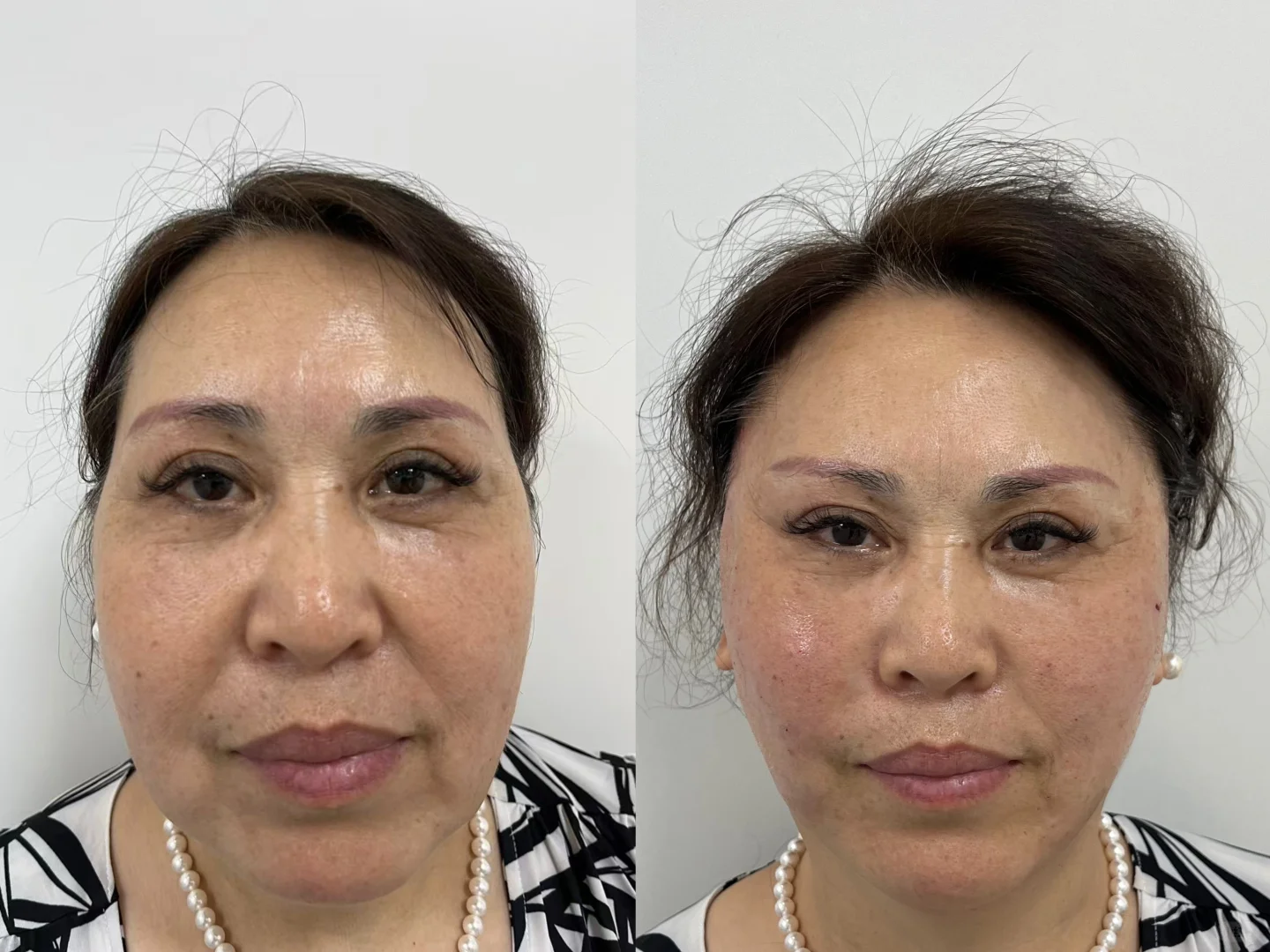 做了个面部提升