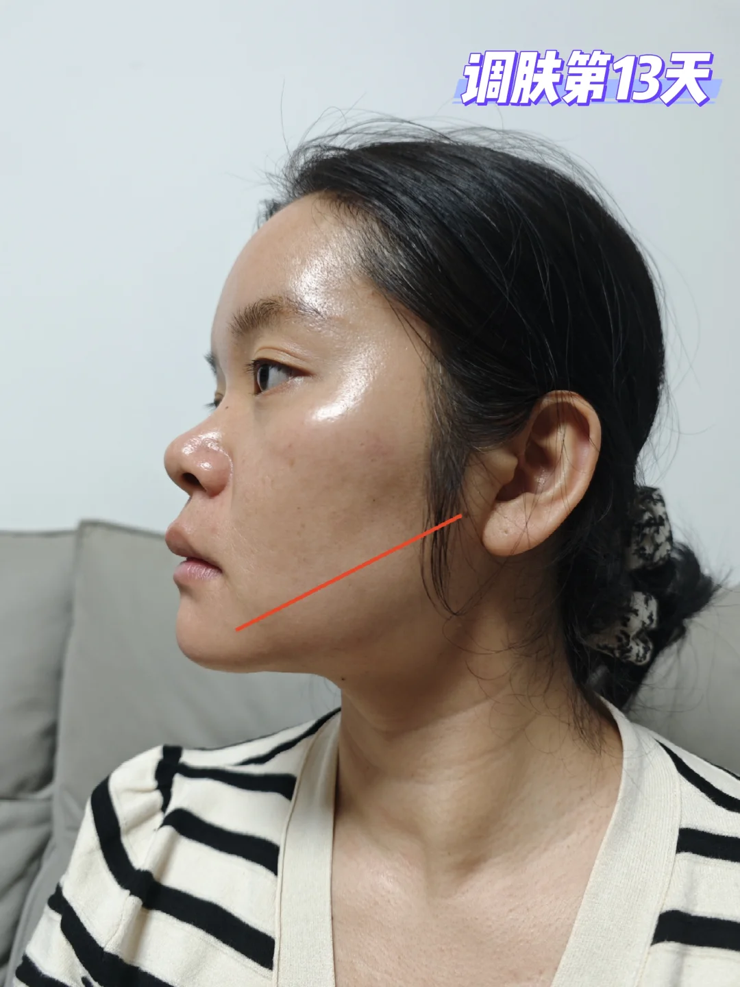 黄褐斑有在淡化