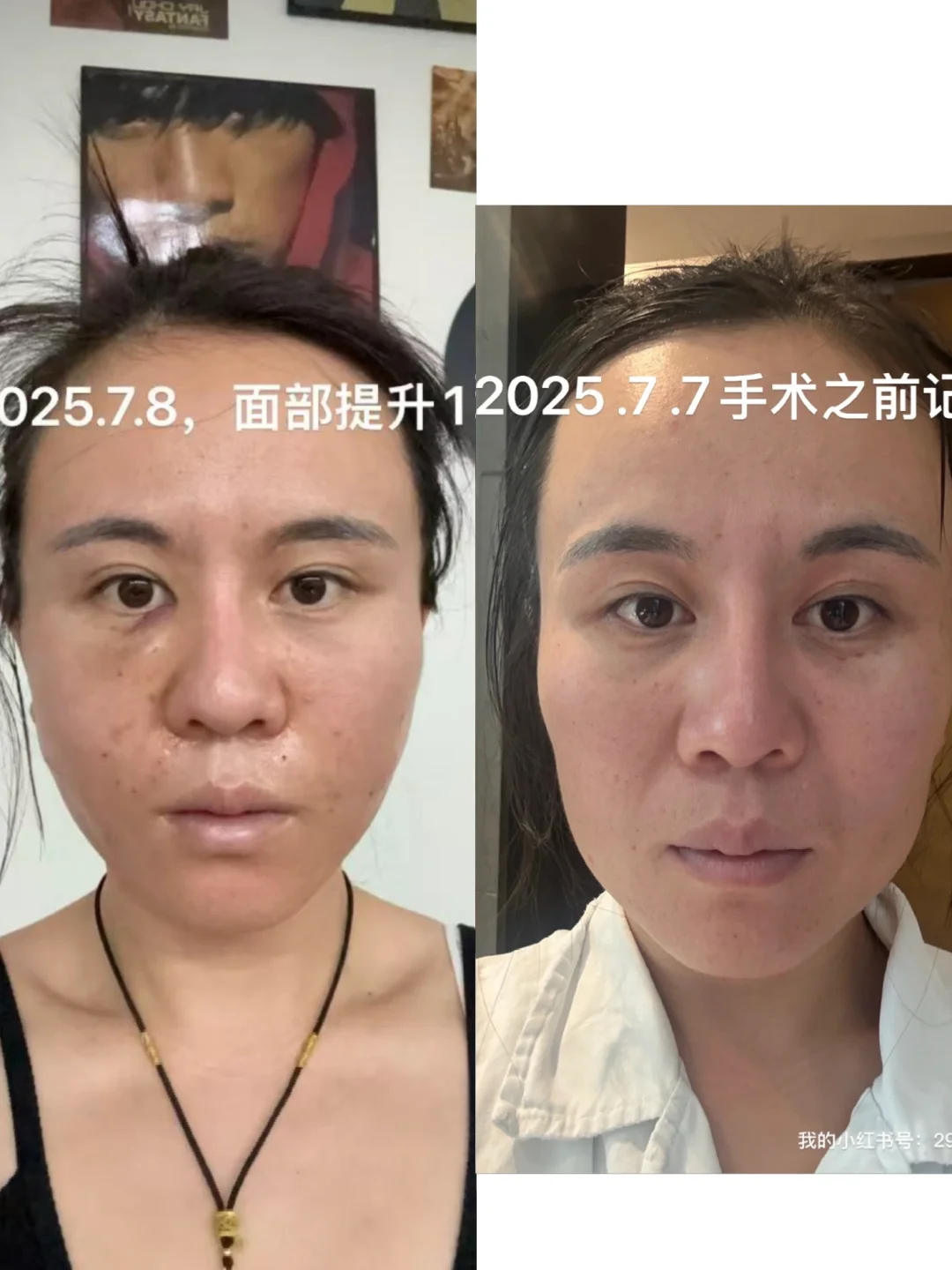 面部垂直提升，苹果肌复位恢复第一天