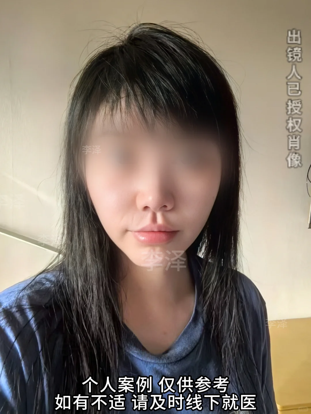 天津的求美者人中三件套术后第一天反馈