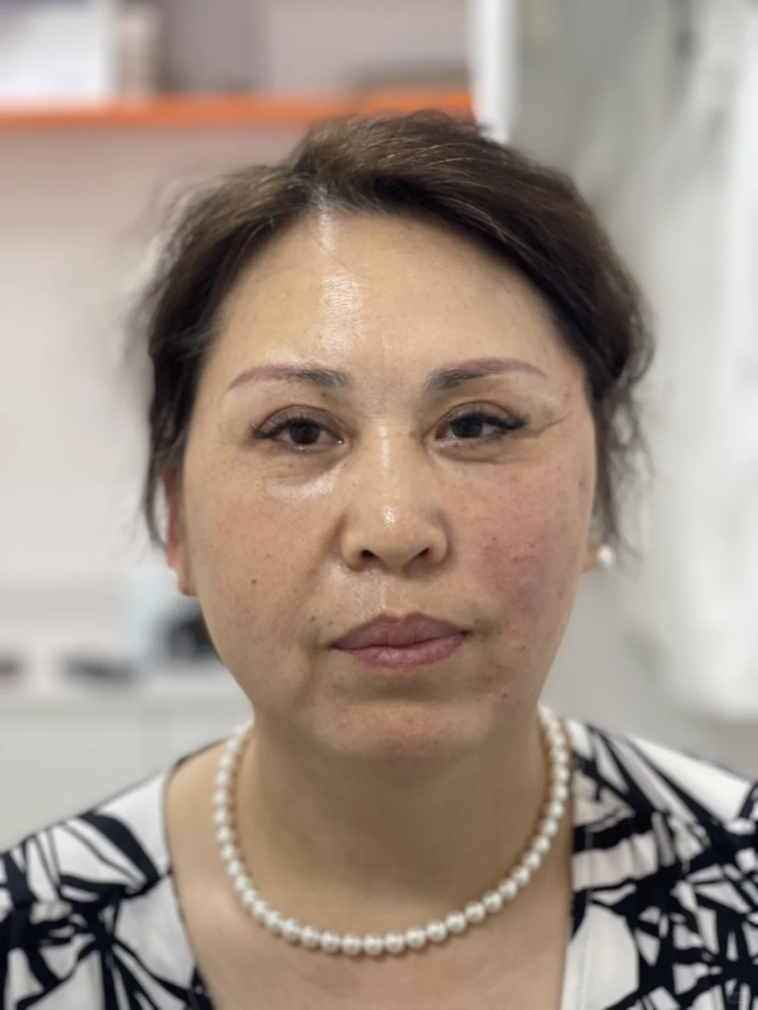 做了个面部提升