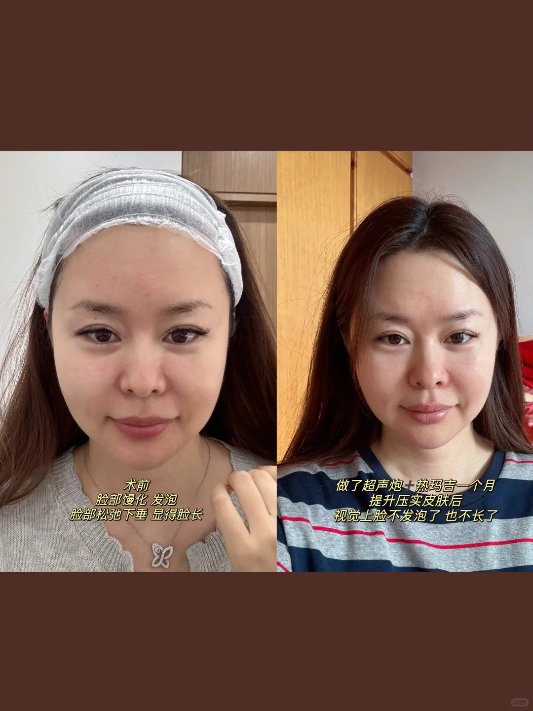 超声炮➕热玛吉一个月的对比