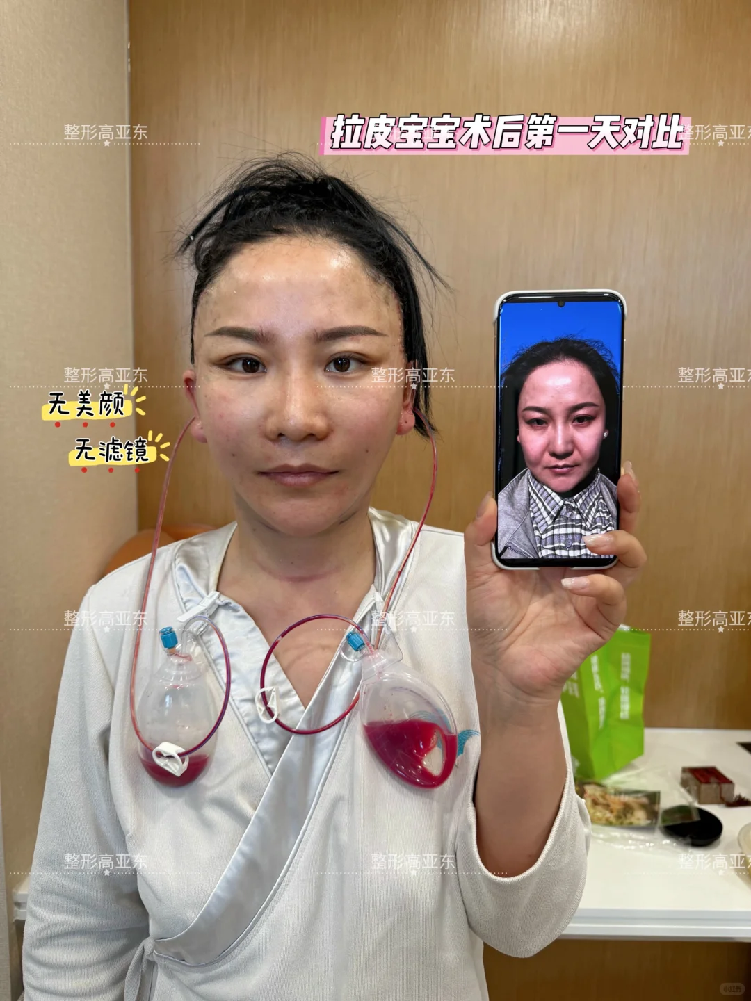 拉皮术后第一天无美颜高清图