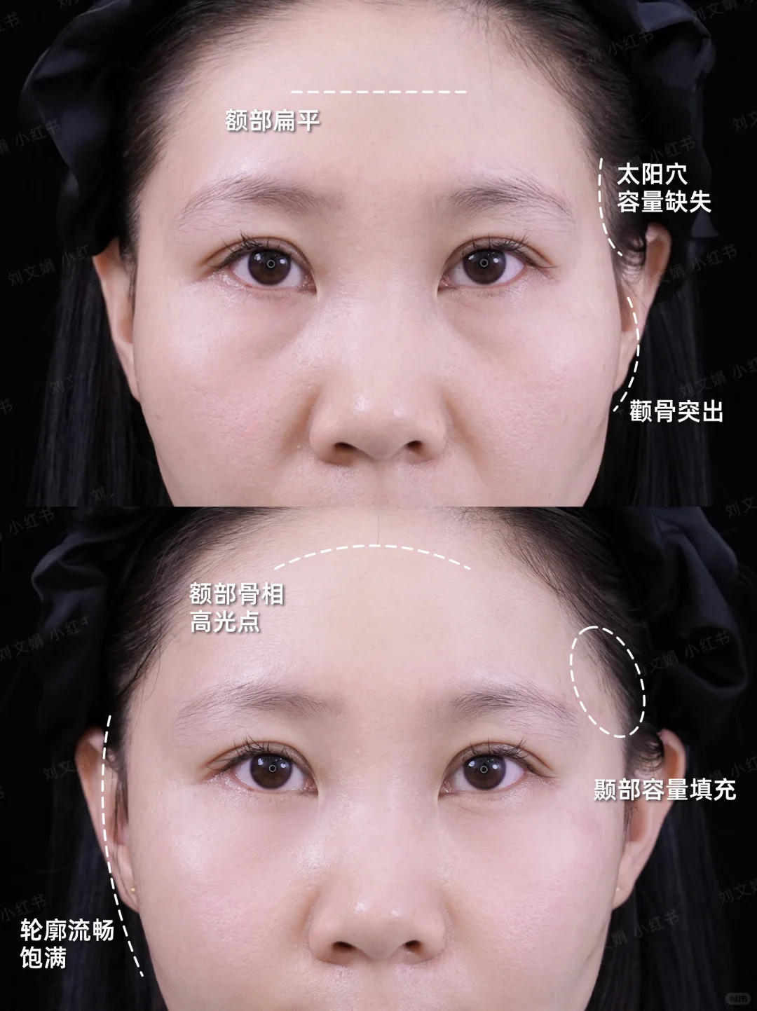 石家庄玻尿酸丨5ml太阳穴凹陷轮廓微调