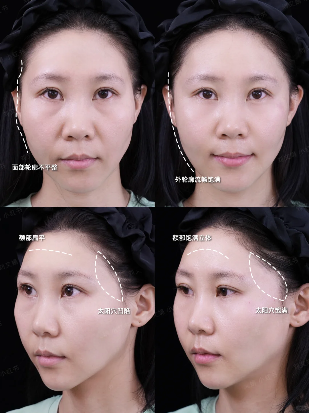 石家庄玻尿酸丨5ml太阳穴凹陷轮廓微调