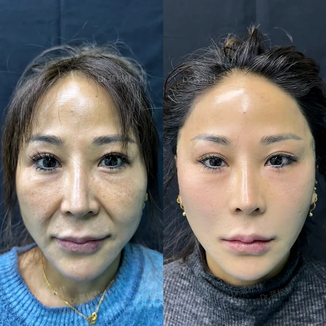 48岁阿姨全面部复位提升后➡️该叫小姐姐了