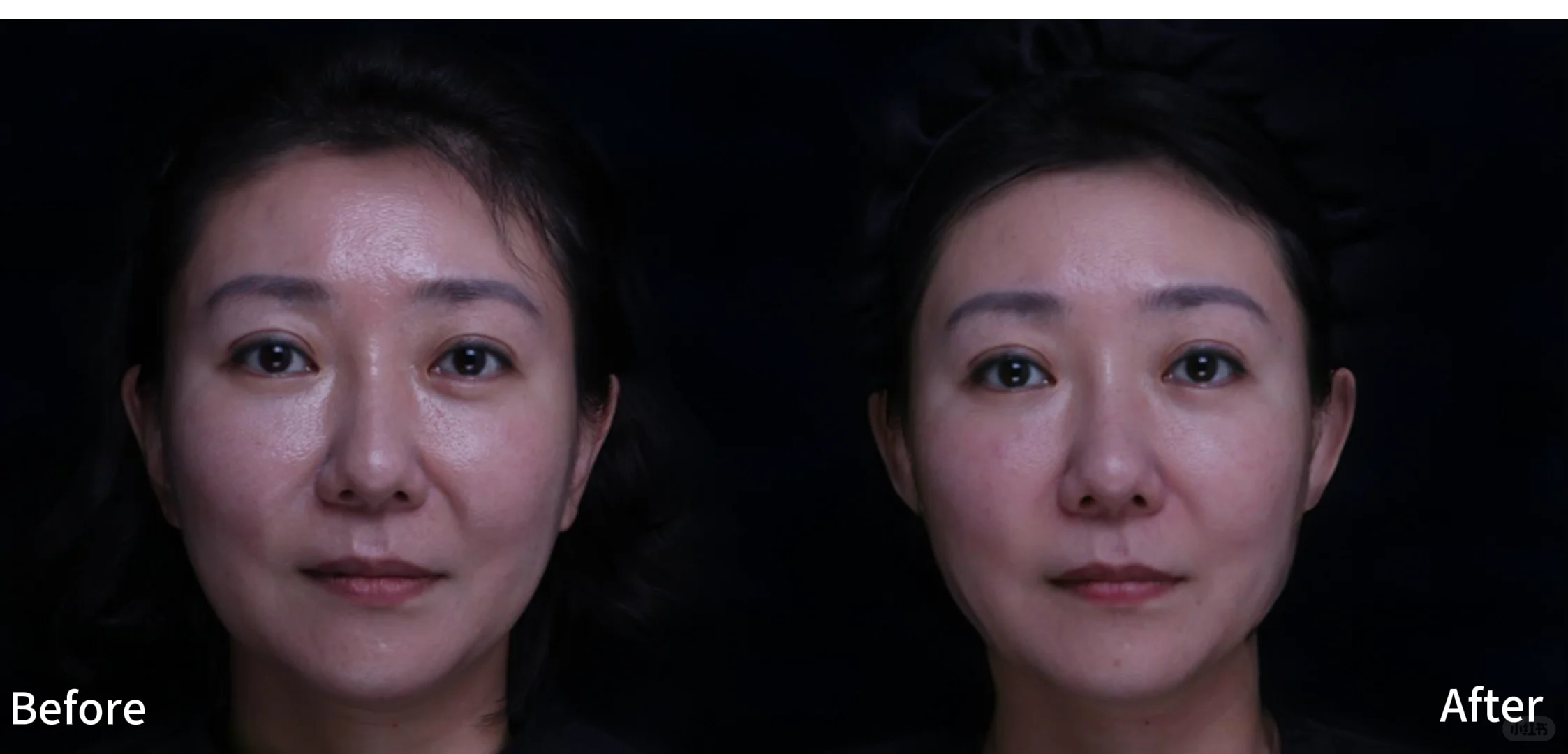 有1说1，美拉美之后，对自己的法令纹很满意