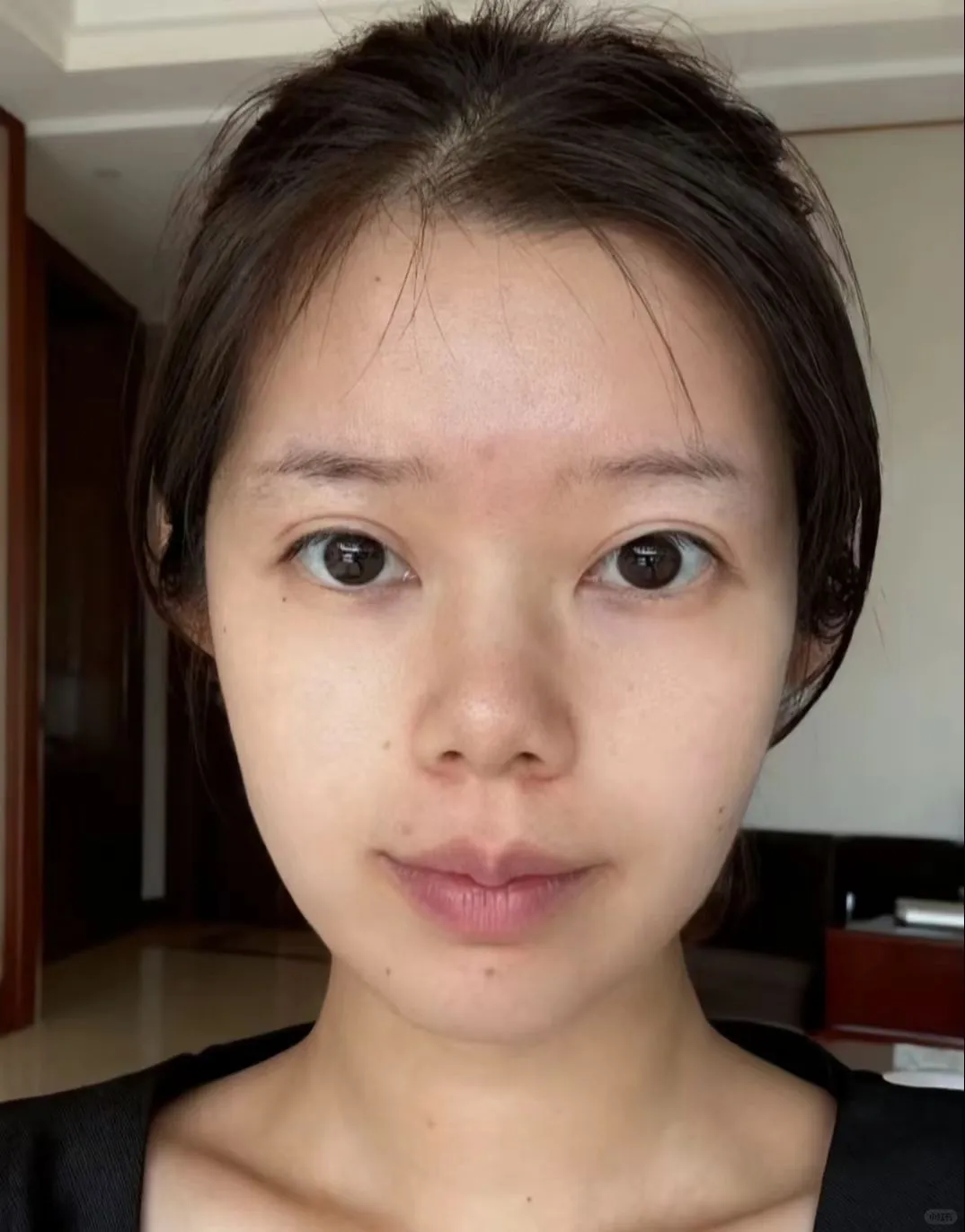 颞区丰颜填完，原相机直拍