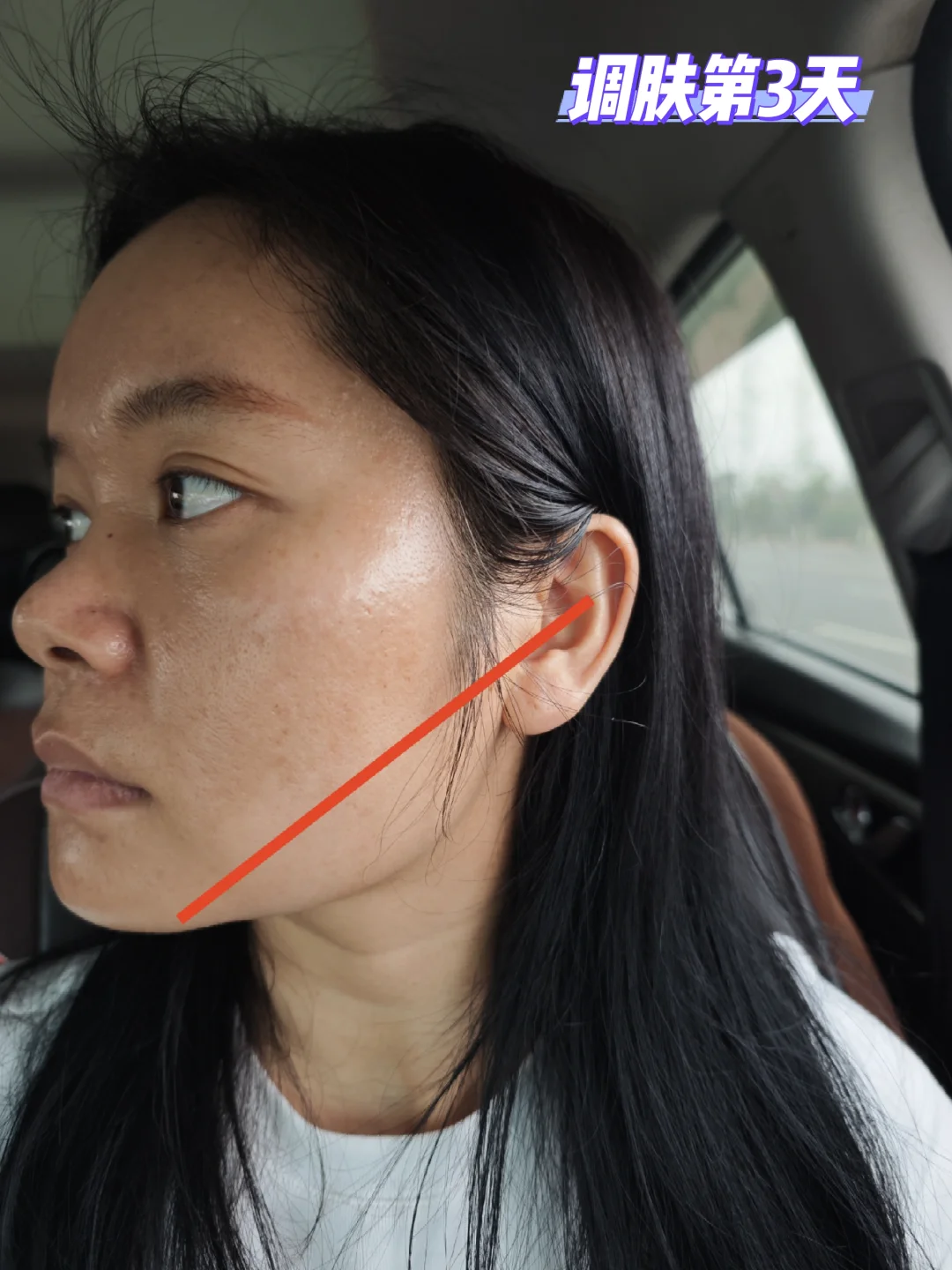 黄褐斑有在淡化