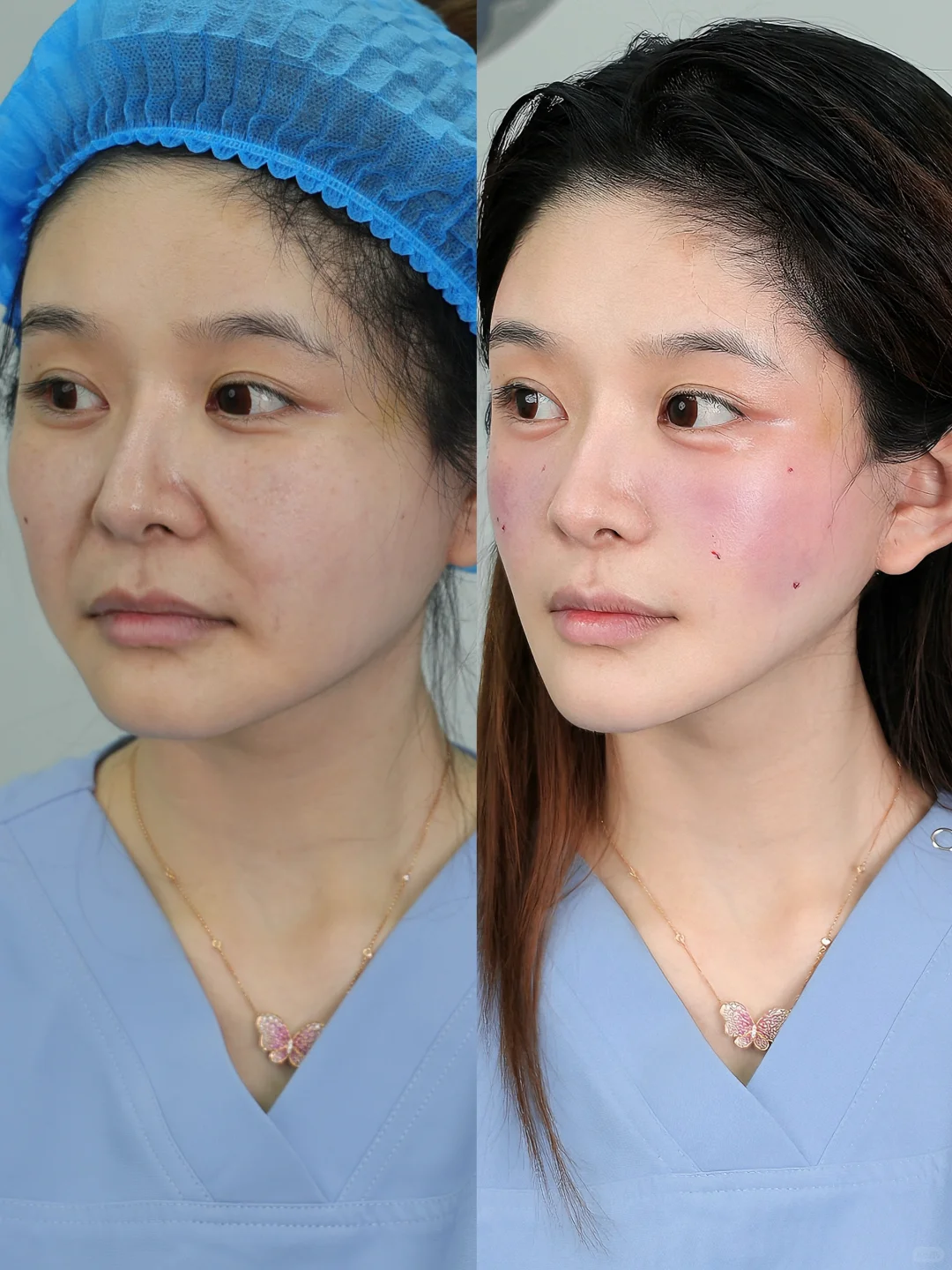 去馒➕提升❗️苹果肌调整思路