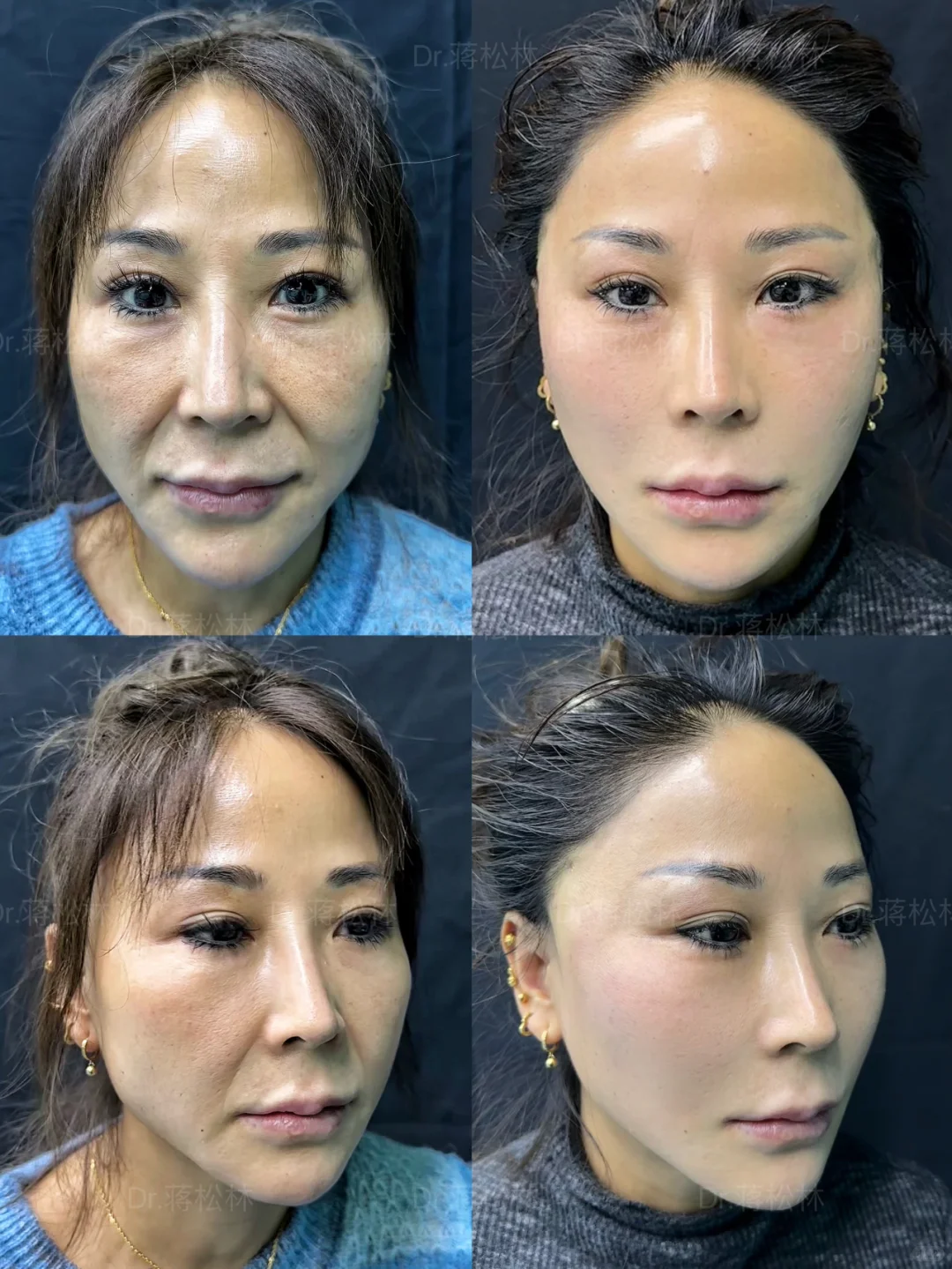 48岁阿姨全面部复位提升后➡️该叫小姐姐了