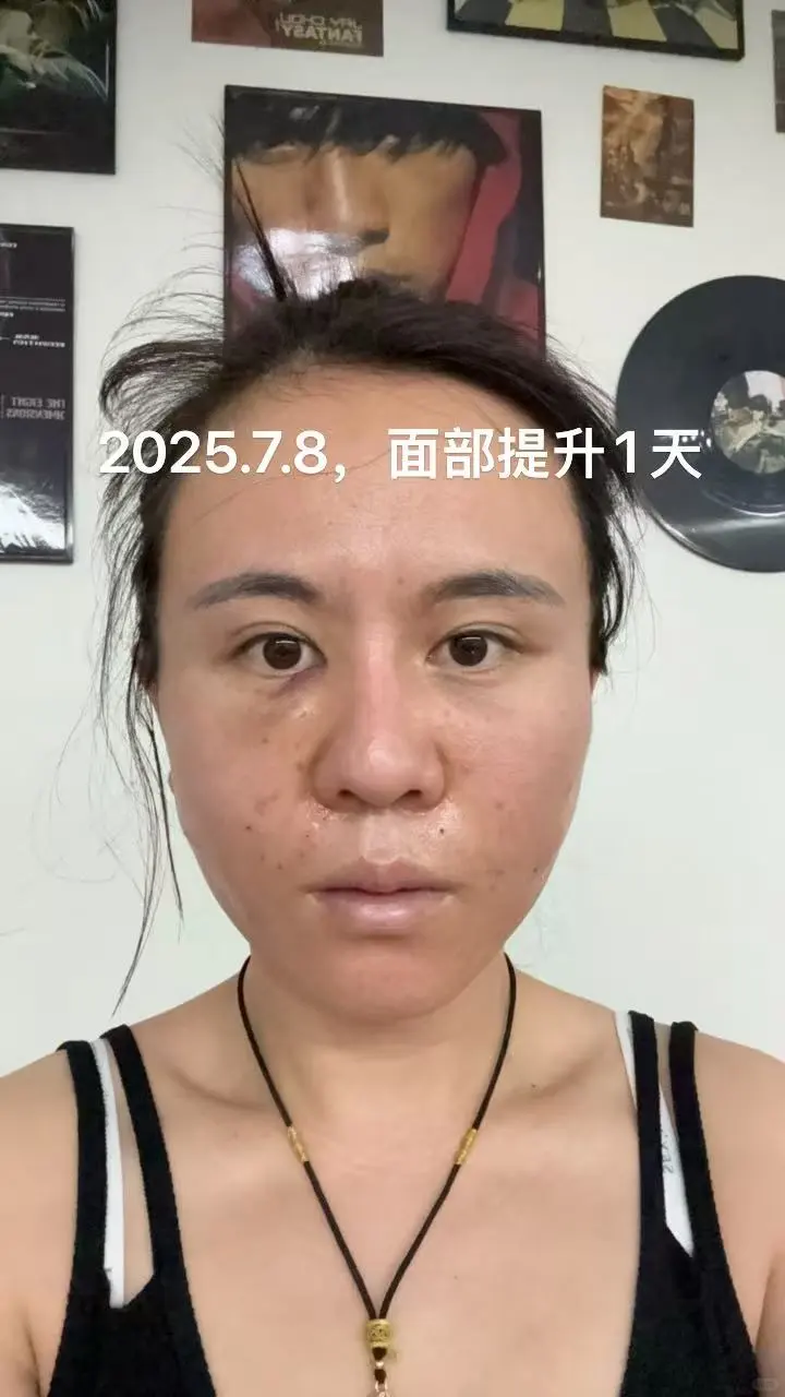 面部垂直提升，苹果肌复位恢复第一天