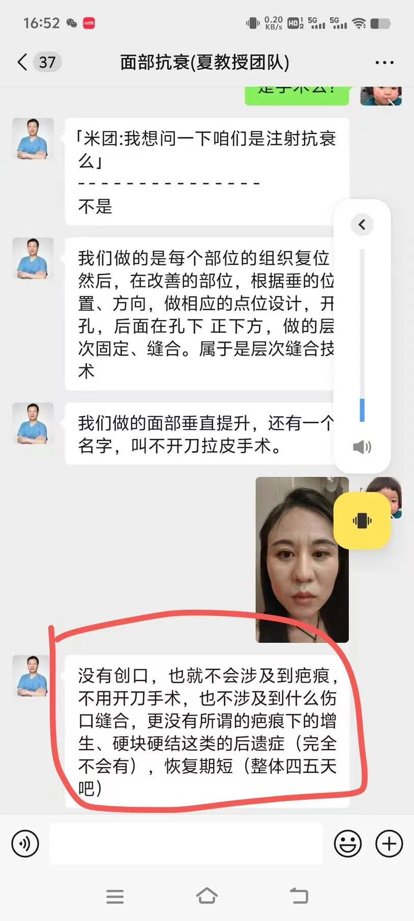 面部垂直提升，苹果肌复位恢复第一天