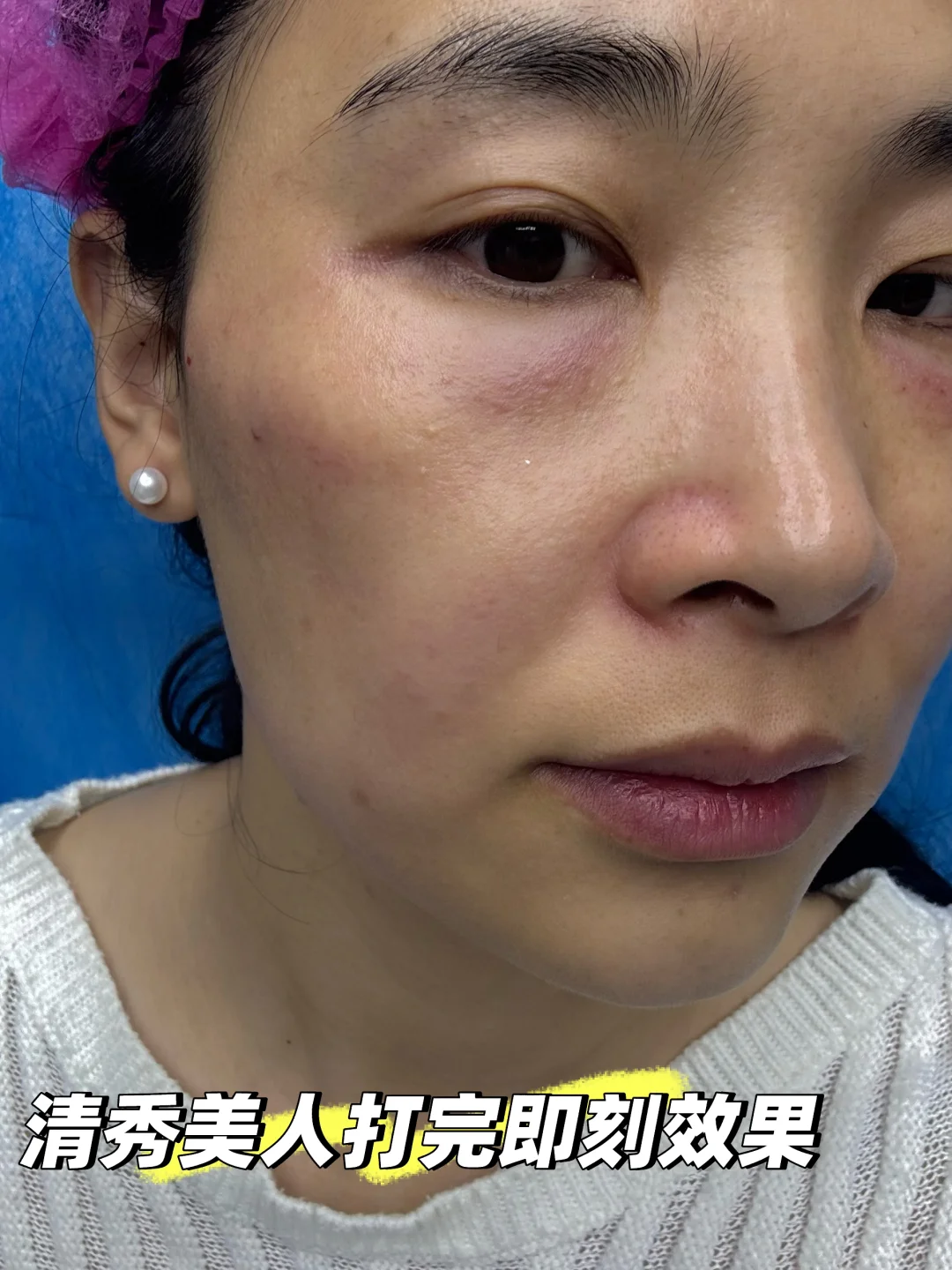 很多人不理解，为什么没填充面部也馒化了呢？