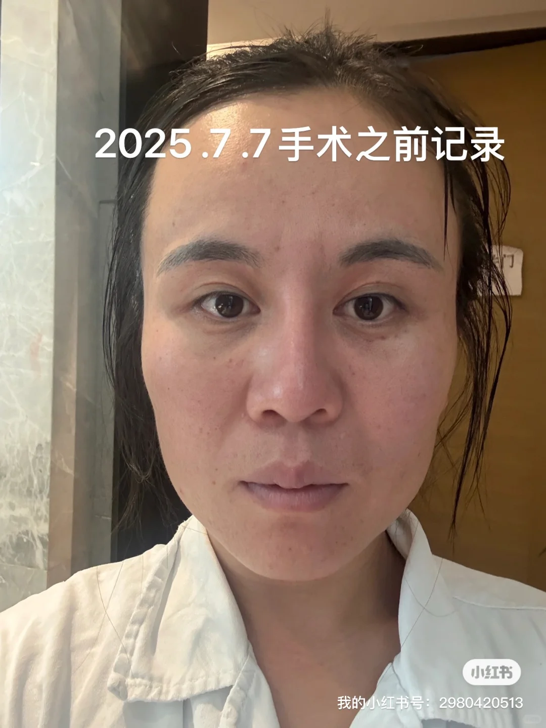 面部垂直提升，苹果肌复位恢复第一天