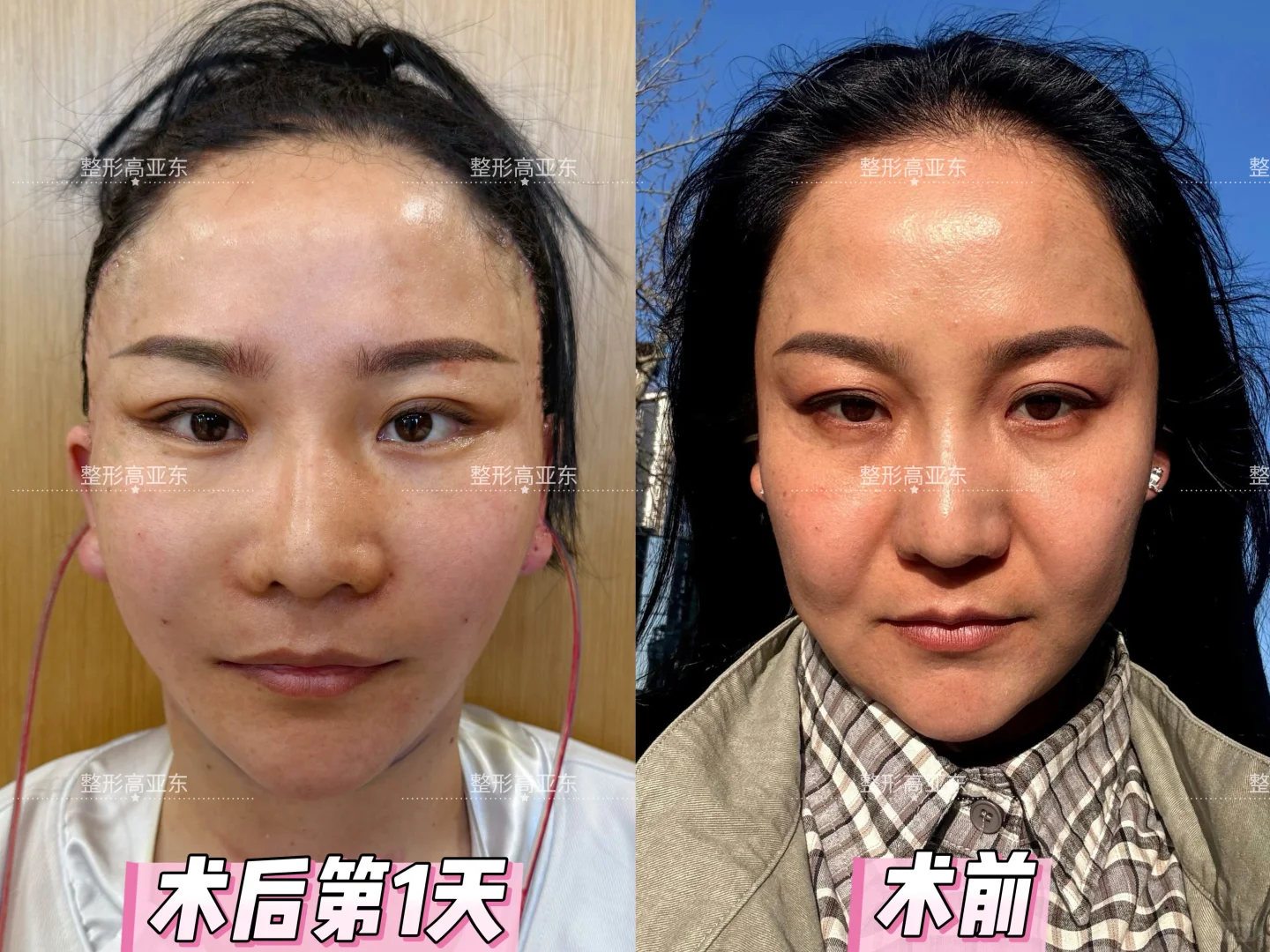 拉皮术后第一天无美颜高清图