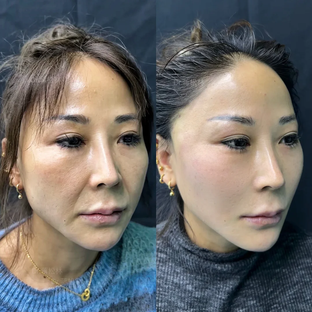 48岁阿姨全面部复位提升后➡️该叫小姐姐了