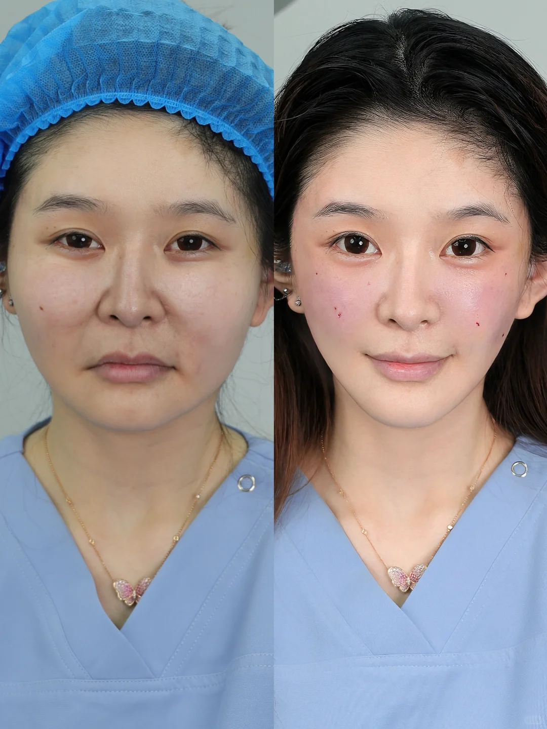 去馒➕提升❗️苹果肌调整思路