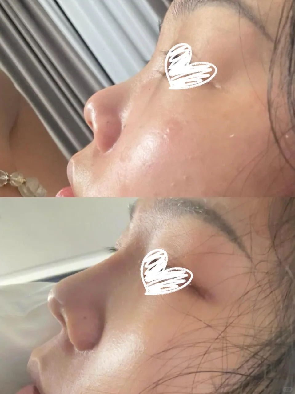 宽眼距+塌鼻梁的痛，谁懂啊！