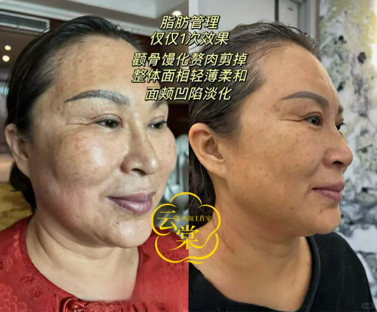 武清55岁大姐脂肪管理，仅仅1次效果的对比！