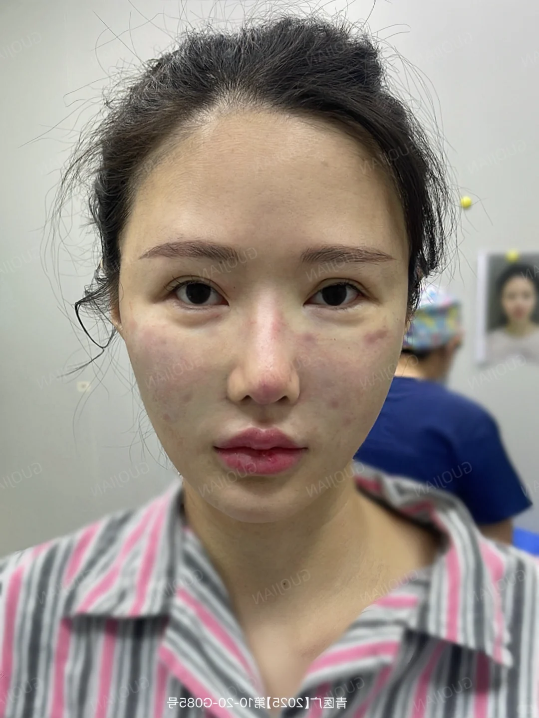 苹果肌打薄丨馒化轻薄变美思路～