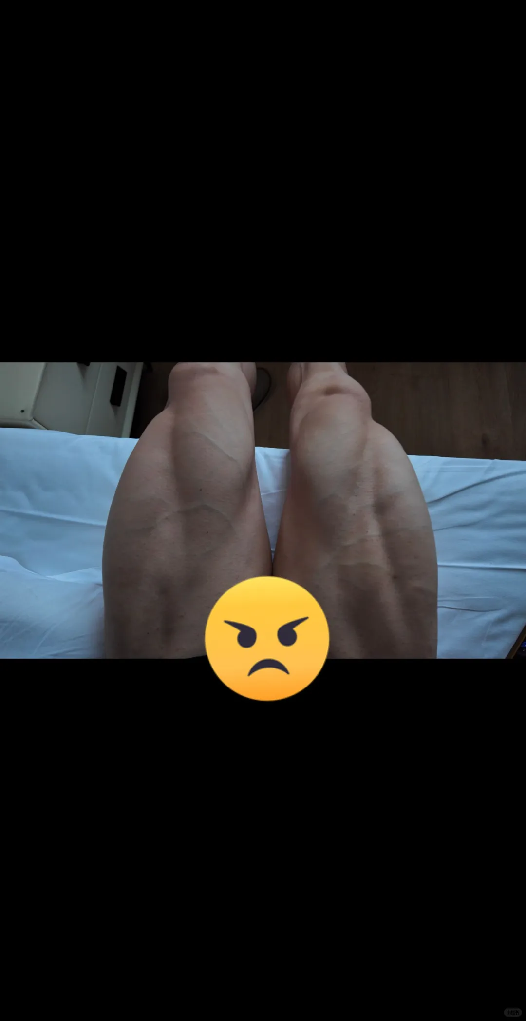 怎么一睡醒腿就变这样了😅😅