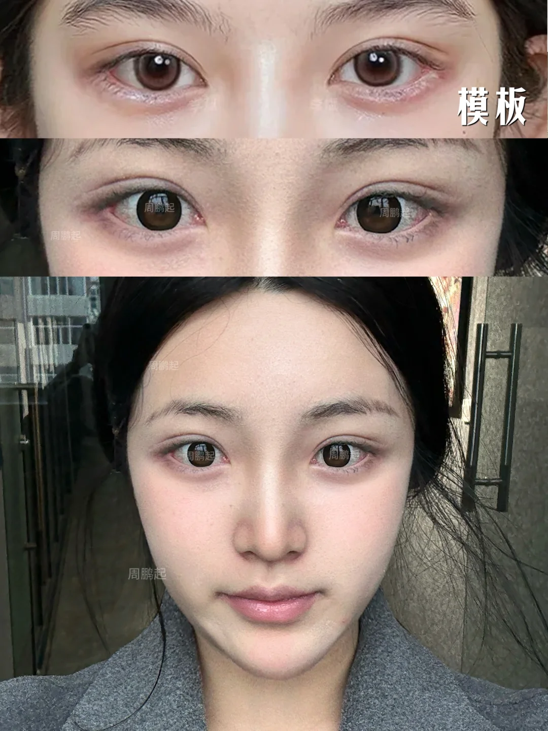 双眼皮线条不流畅眼窝凹陷～三个月灰复对比