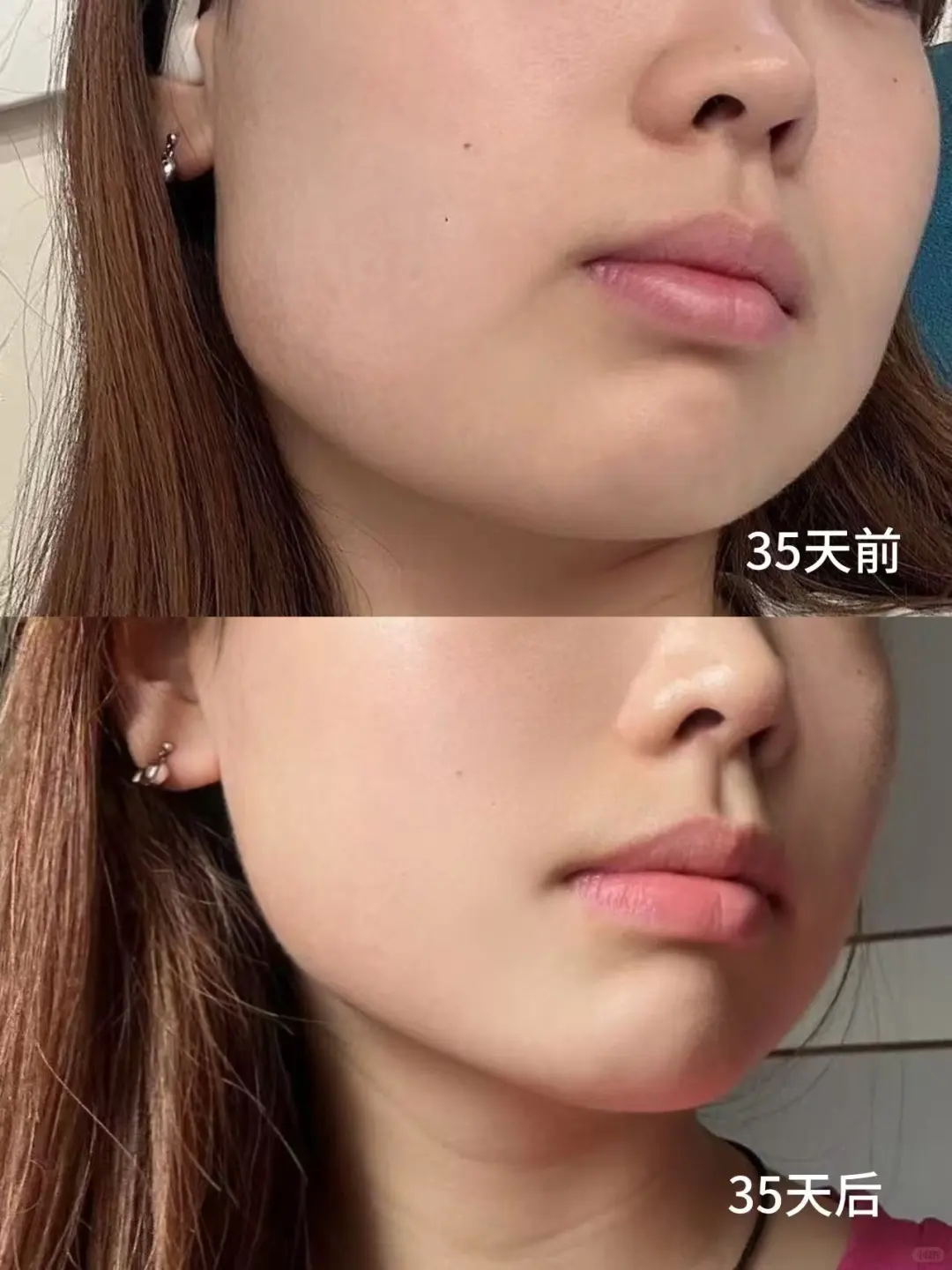 （新附对比）悄咪咪去做了人生第一次瘦脸针