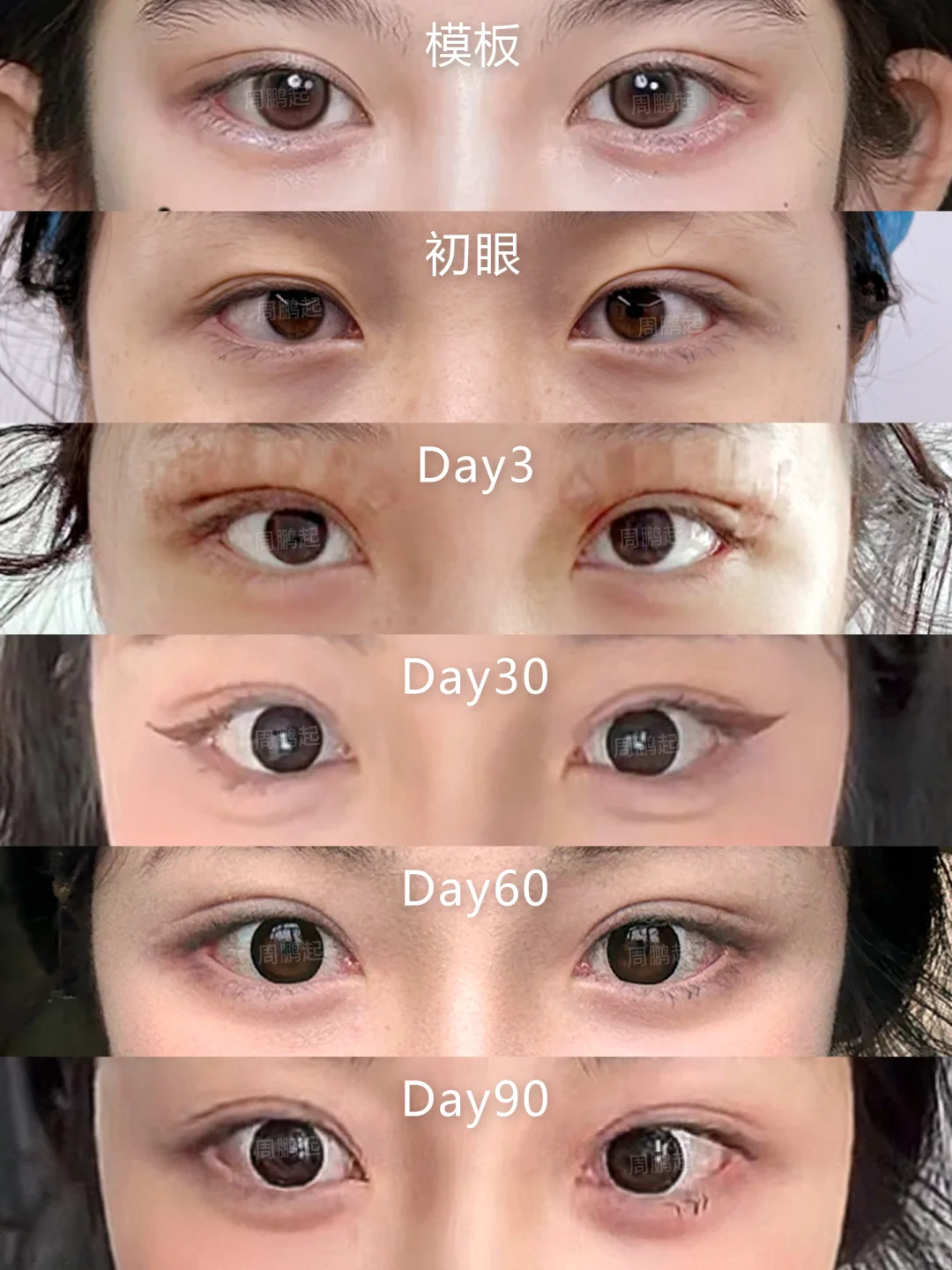 双眼皮线条不流畅眼窝凹陷～三个月灰复对比