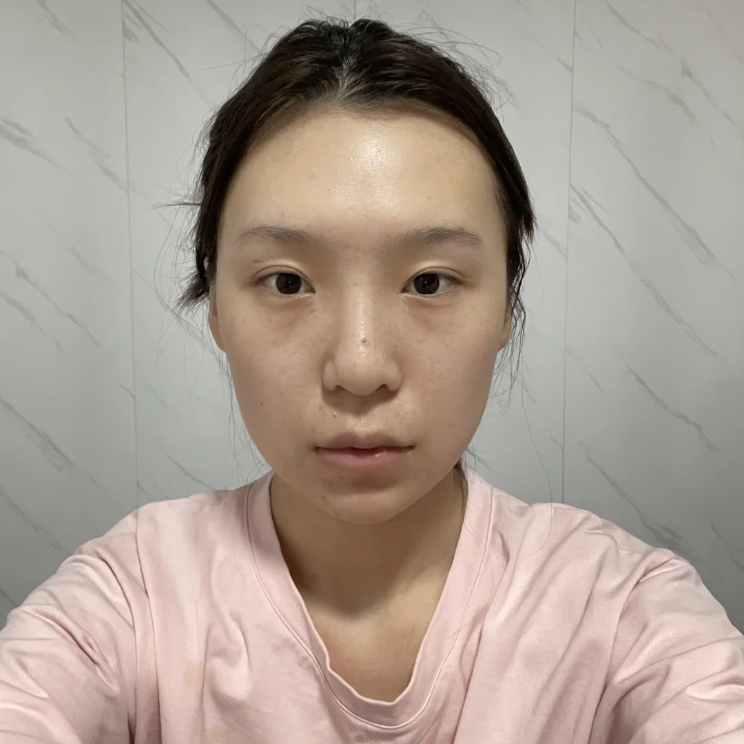 四年花费50w do脸前后对比