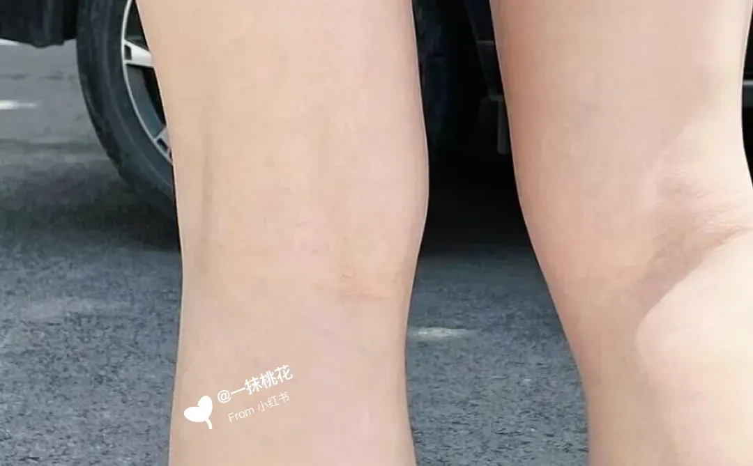 后腿的纹不到俩月就没喽～