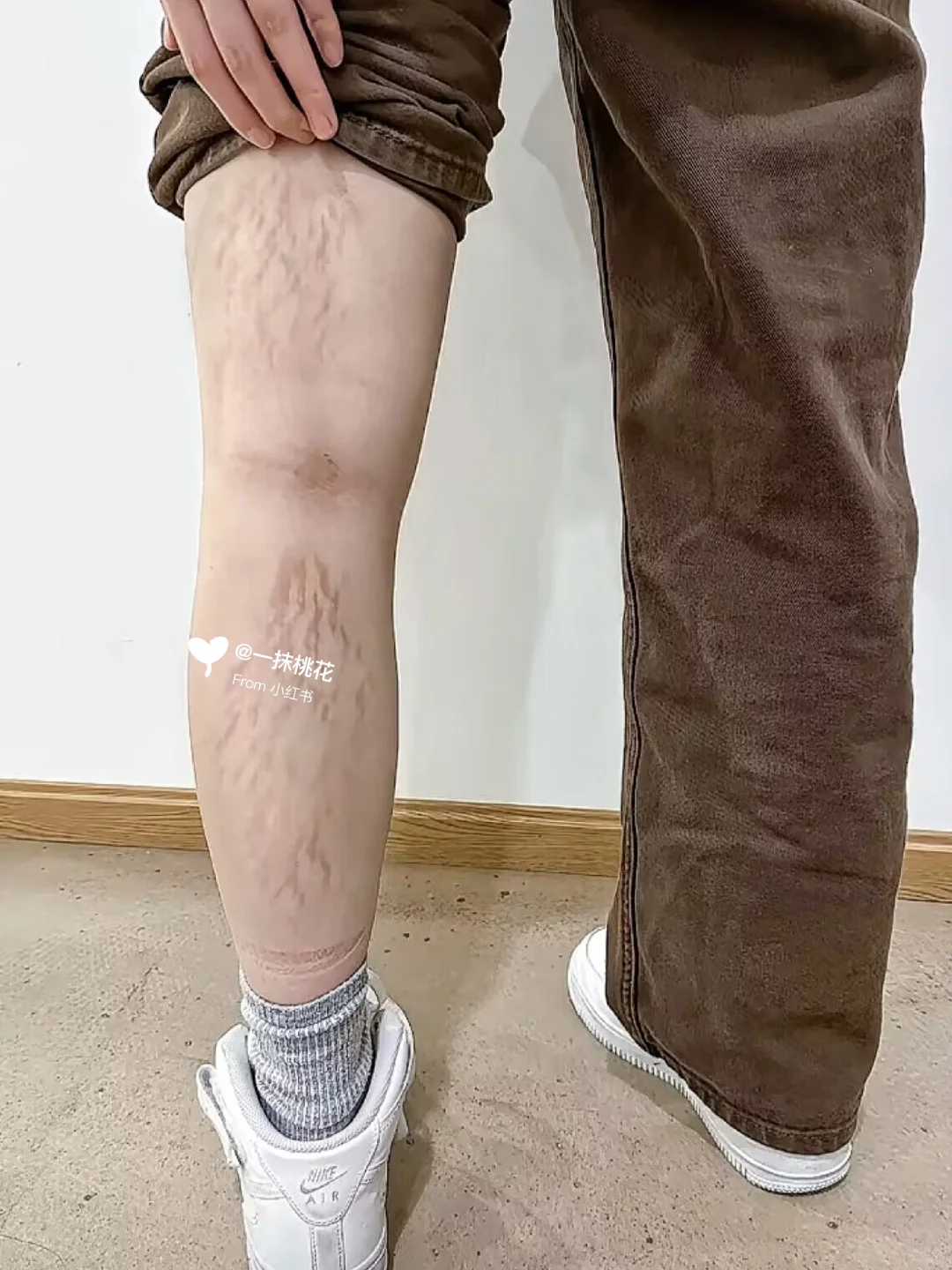 后腿的纹不到俩月就没喽～