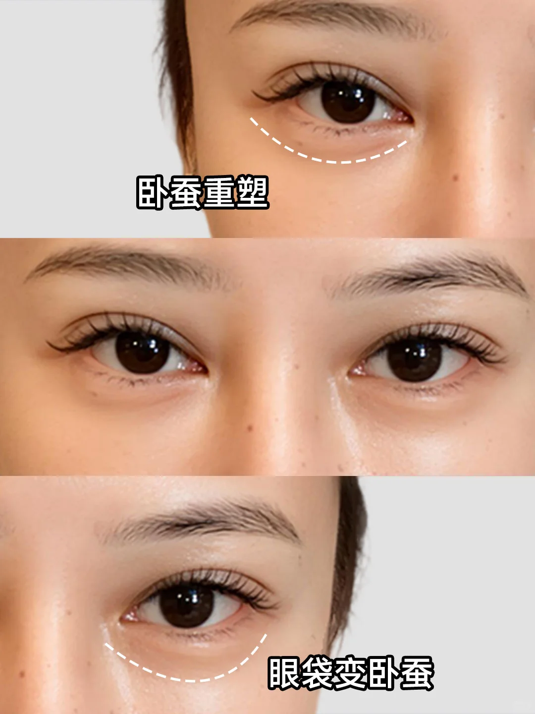 眼袋修复|卧蚕重塑，灵动双眼